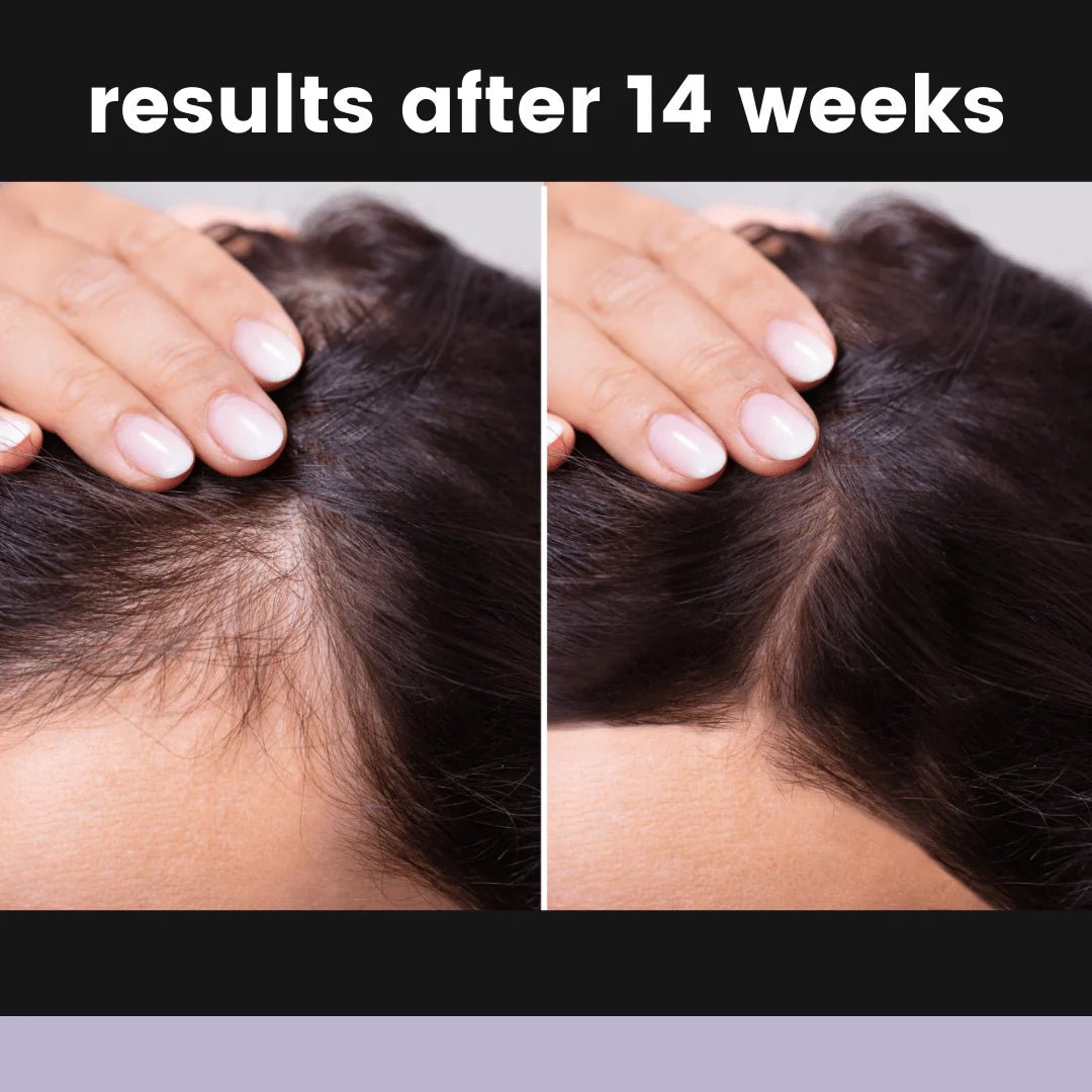 Hair growth before and after 14 weeks of treatment